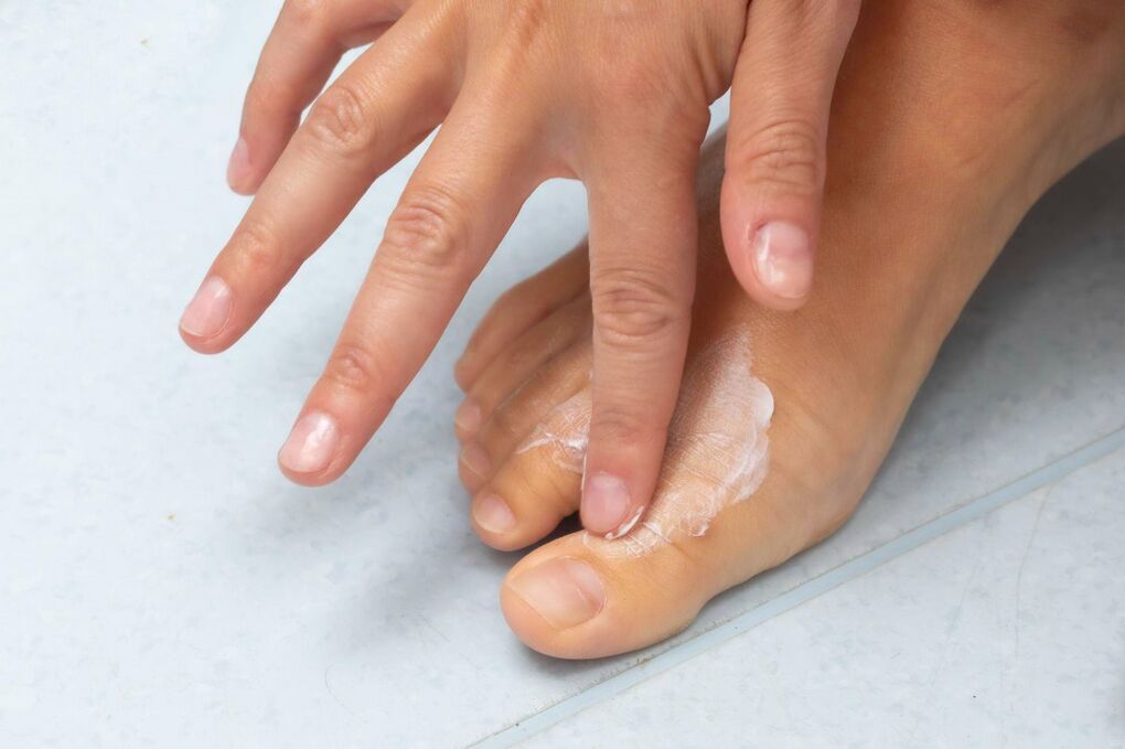 Applicazione della crema Zxcvbnmqwert dal fungo tra le dita dei piedi