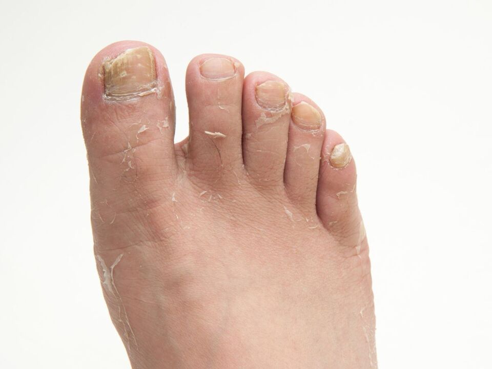 Fungo sulla pelle delle gambe e il suo trattamento con crema zxcvbnmqwort