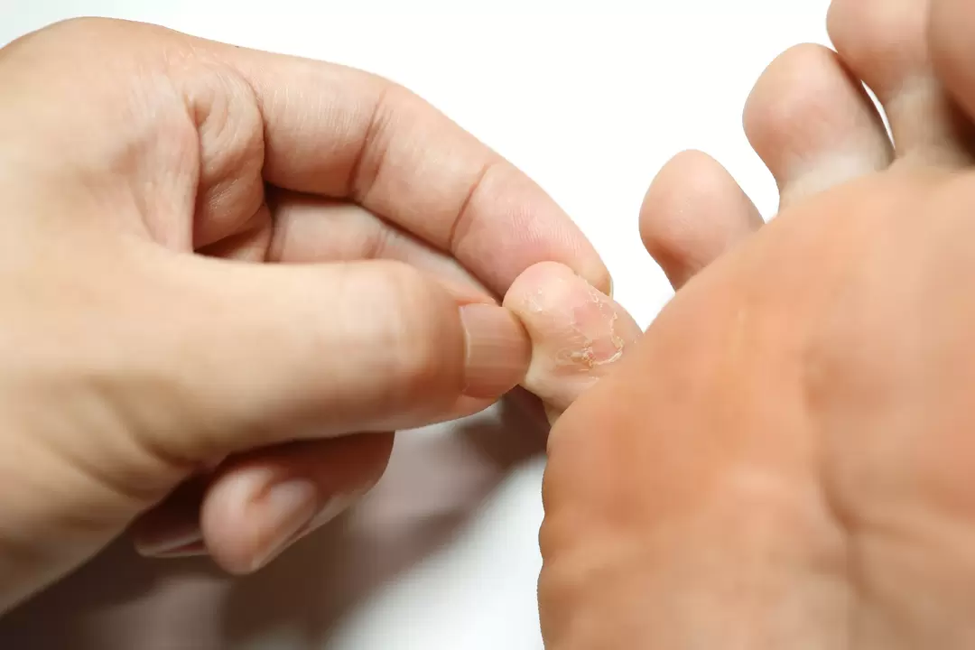 Fungo sulle dita e il suo trattamento con crema Zxcvbnmqwert con crema