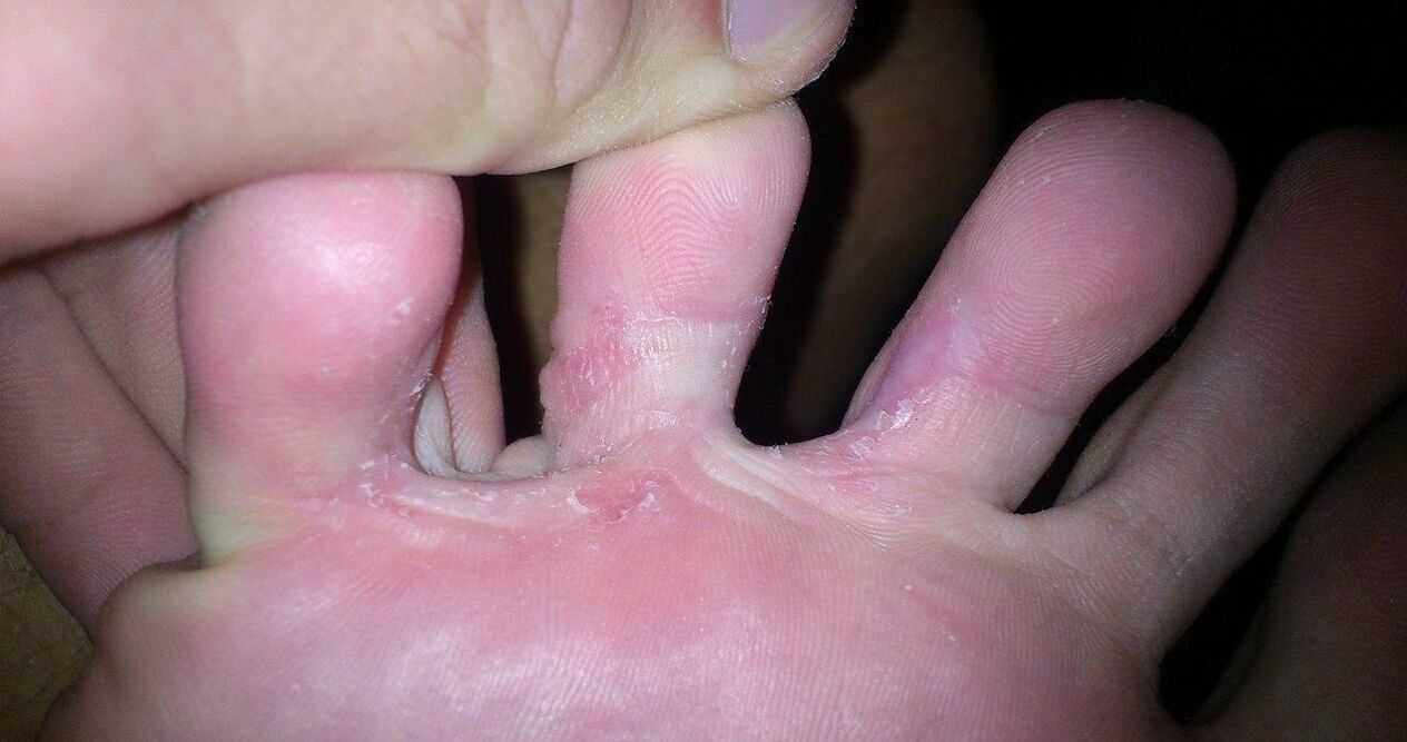 Fungo tra le dita dei piedi al trattamento della crema Zxcvbnmqwert