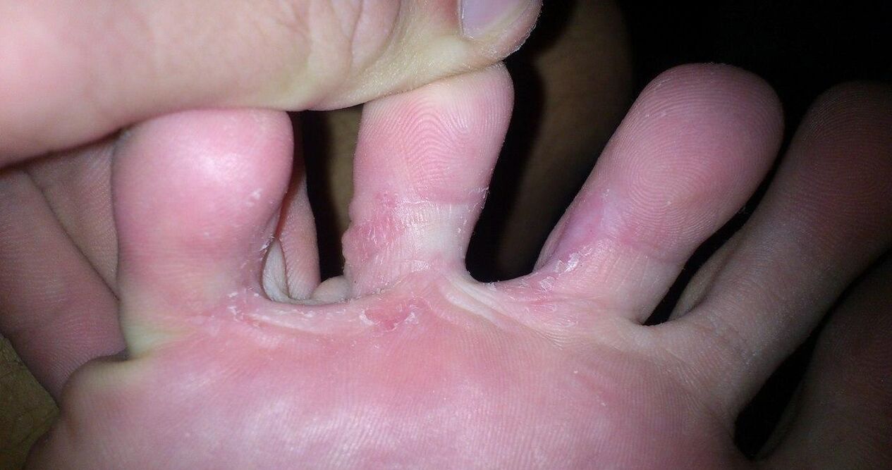 Fungo tra le dita per trattare la crema di demossil
