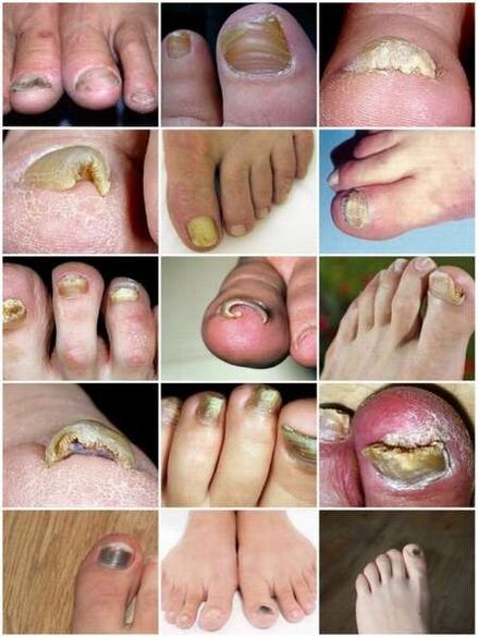 Infezione fungina della lamina ungueale