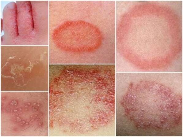 Tricofitosi della pelle delle gambe