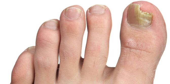 infezione fungina della lamina ungueale